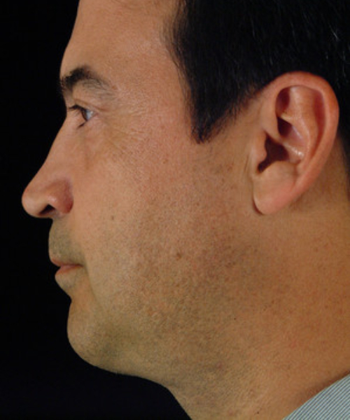 after chin implant male patient left side view case 4789