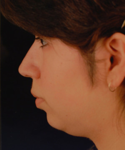 before chin implant female patient left side view case 4863