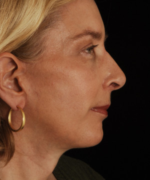 after chin implant female patient right side view case 4866