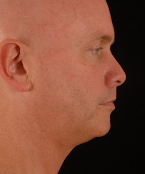 before chin implant male patient right side view case 4872