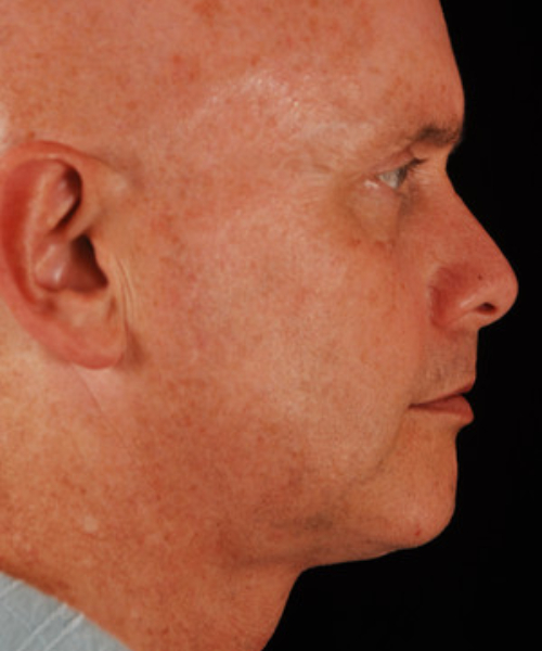 after chin implant male patient right side view case 4872