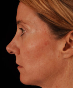 before chin implant female patient left side view case 4878