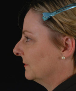 before chin implant female patient left side view case 4881