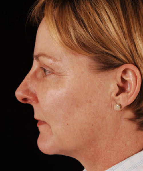 after chin implant female patient left side view case 4881