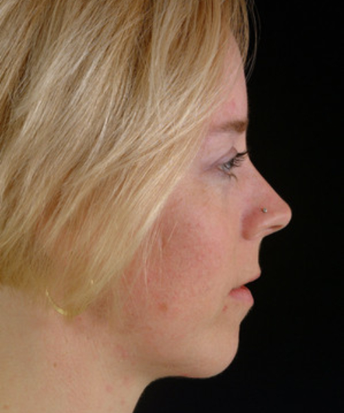 before chin implant female patient right side view case 4953