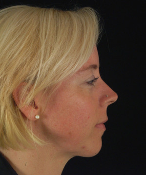 after chin implant female patient right side view case 4953