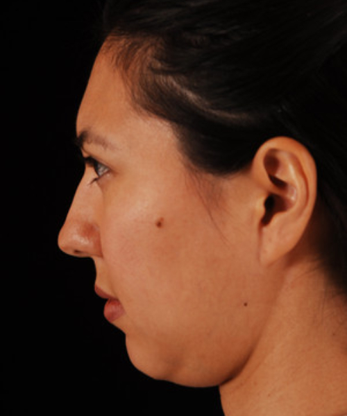 before chin implant female patient left side view case 4956