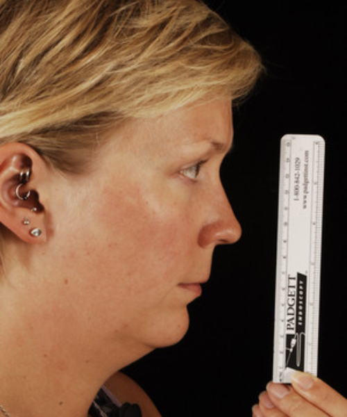 before chin implant female patient right side view case 4959