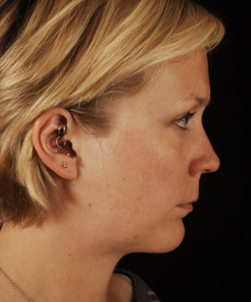 after chin implant female patient right side view case 4959