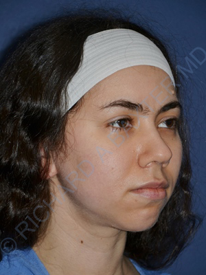 before chin implant right angle view case 4083