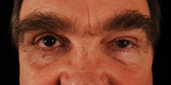 before eyelid surgery male patient front view case 5469