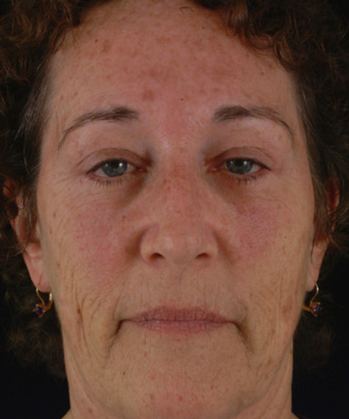 after eyelid surgery female patient front view case 5472