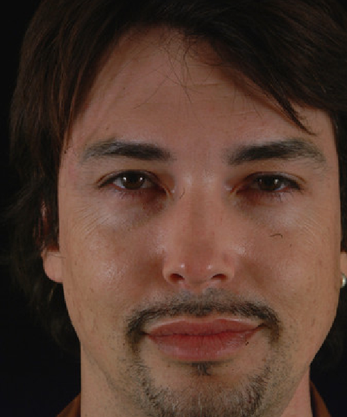 before eyelid surgery male patient front view case 5475