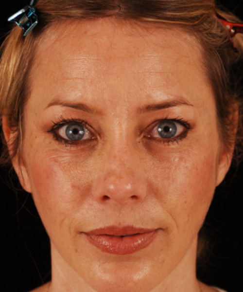 before eyelid surgery female patient front view case 5478