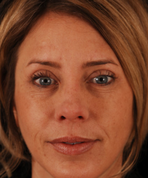after eyelid surgery female patient front view case 5478