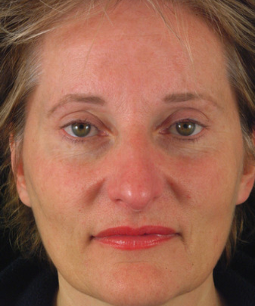 after eyelid surgery female patient front view case 5484