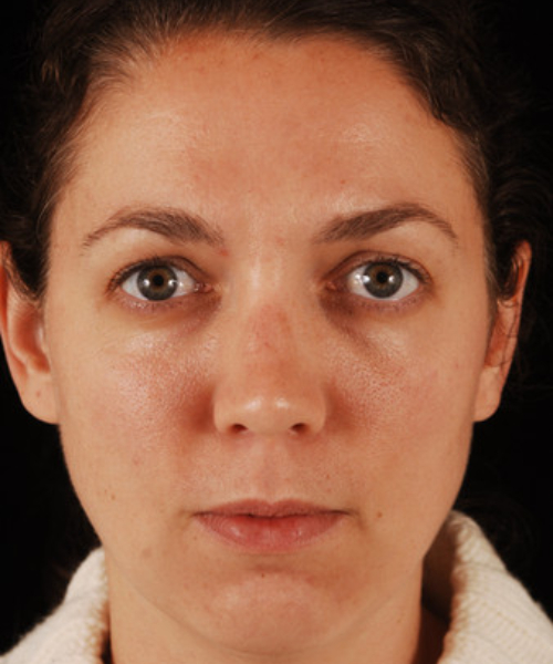 before eyelid surgery female patient front view case 5487
