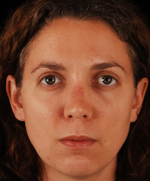 after eyelid surgery female patient front view case 5487