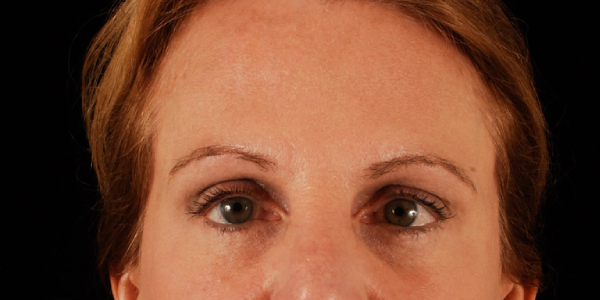 after eyelid surgery female patient front view case 5493