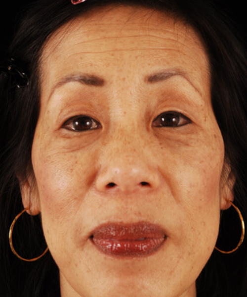 before eyelid surgery female patient front view case 5496