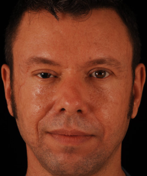 before eyelid surgery male patient front view case 5509