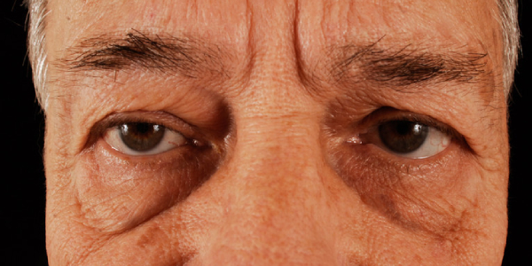 before eyelid surgery front view case 5512