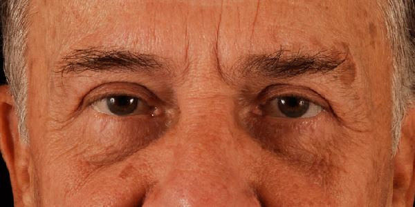 after eyelid surgery front view case 5512