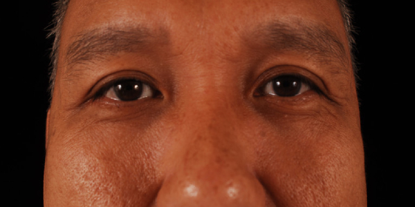 after eyelid surgery front view case 5515