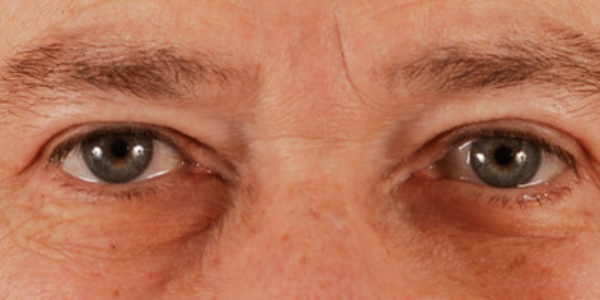 after eyelid surgery male patient front view case 5527