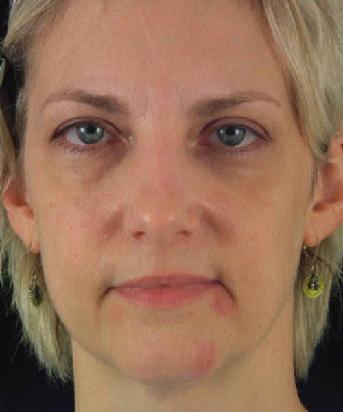 before eyelid surgery female patient front view case 5530