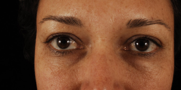before eyelid surgery female patient front view case 5536