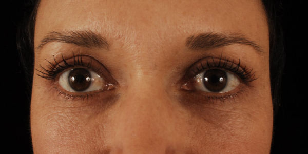 after eyelid surgery female patient front view case 5536