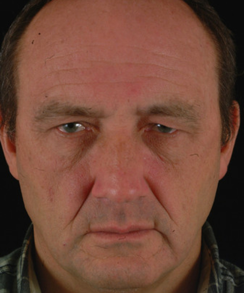 before eyelid surgery male patient front view case 5539