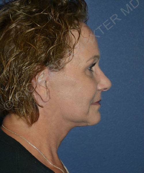 after facelift | neck lift female patient right side view case 4798