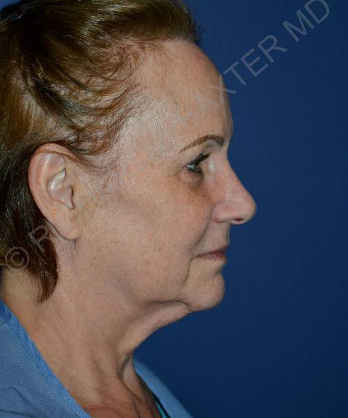 before facelift | neck lift female patient right side view case 4798