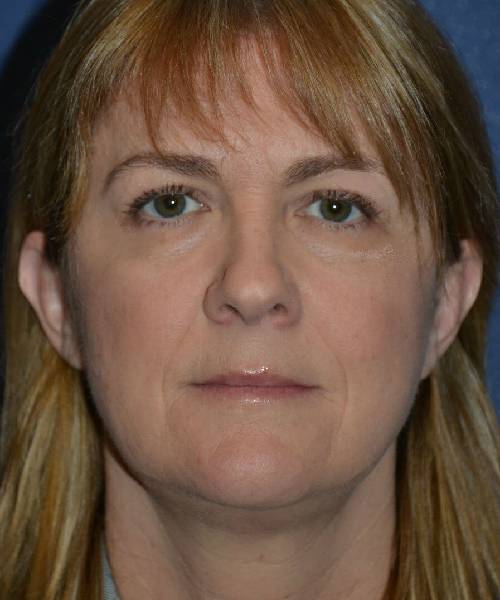 after facelift | neck lift female patient front view case 4808