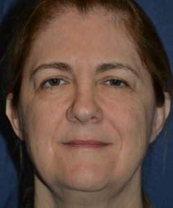 before facelift | neck lift female patient front view case 4808