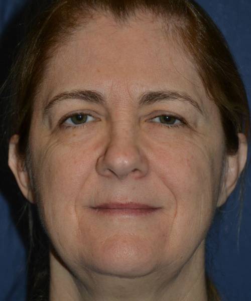 before facelift | neck lift female patient front view case 4808