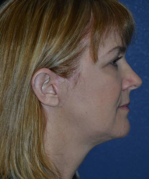 after facelift | neck lift female patient right side view case 4808