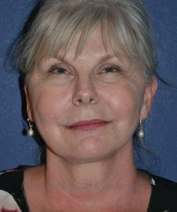 after facelift | neck lift female patient front view case 4813