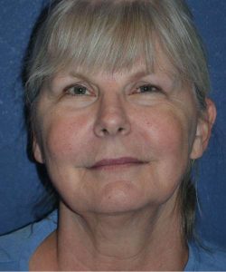 before facelift | neck lift female patient front view case 4813