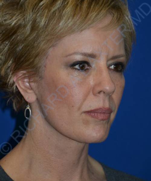 after facelift | neck lift female patient right angle view case 4818