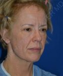 before facelift | neck lift female patient right angle view case 4818
