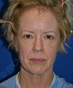 before facelift | neck lift female patient front view case 4818