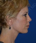 after facelift | neck lift female patient right side view case 4818