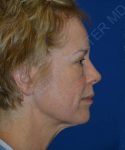 before facelift | neck lift female patient right side view case 4818