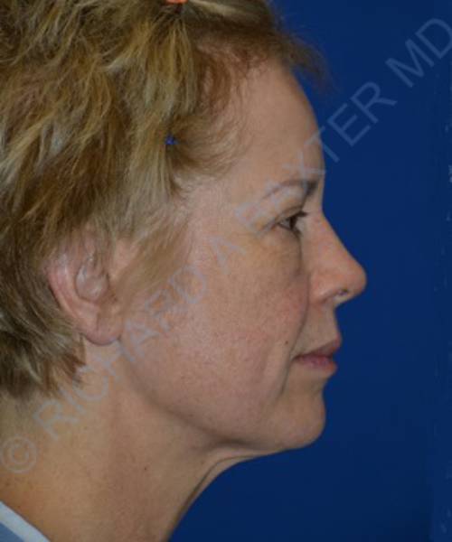 before facelift | neck lift female patient right side view case 4818