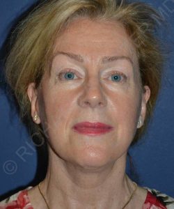 after facelift | neck lift female patient front view case 4826
