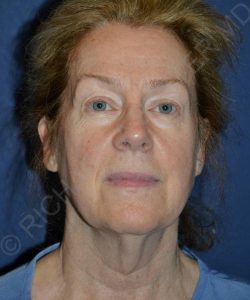 before facelift | neck lift female patient front view case 4826