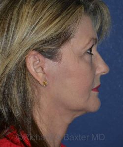 after facelift | neck lift female patient right side view case 4836